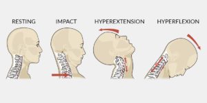 How Much Is Whiplash Worth in a Lawsuit?