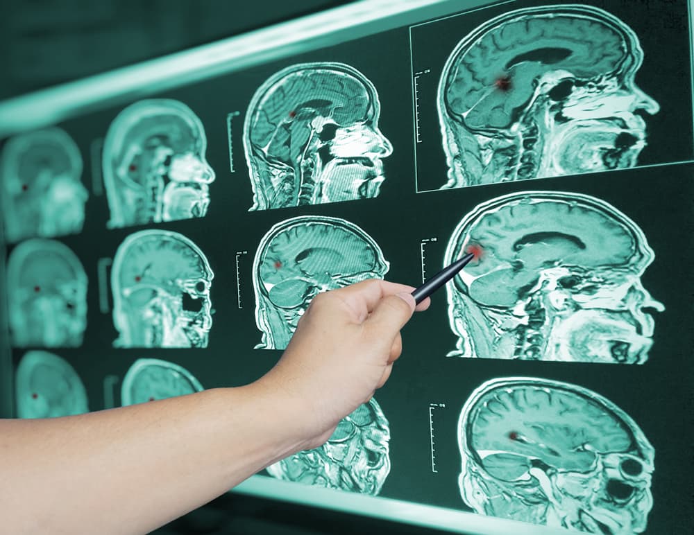 A hand pointing at brain scans on a screen, highlighting areas with red marks.